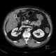 Cortical scar of the kidney, agenesis of cortex of kidney, gallstone: CT - Computed tomography